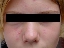 Teenager acne